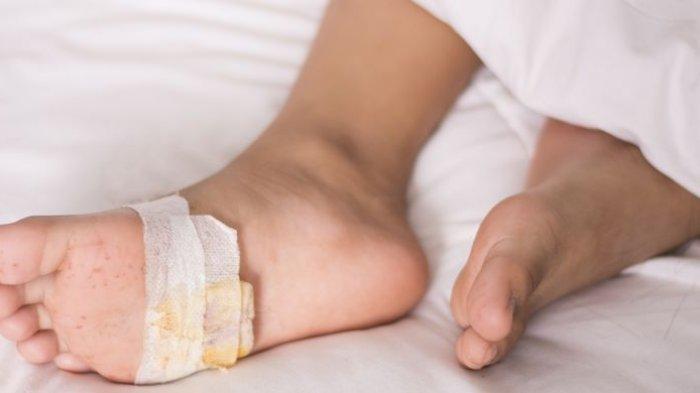 Bahaya Luka Diabetes yang Tidak Dirawat: Kenali Risiko Komplikasinya