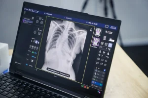 Waspadai Tuberkulosis Laten: Langkah Penting Mencegah Penularan