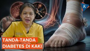 Panduan Perawatan Luka bagi Penderita Diabetes