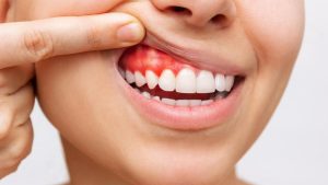 Waspada! Gusi Berdarah Bisa Jadi Tanda Penyakit Jantung dan Diabetes