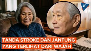 Kenali Tanda Stroke dan Penyakit Jantung dari Ciri di Wajah Anda