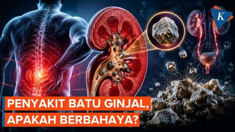 Mengenal Bahaya Penyakit Batu Ginjal dan Dampaknya bagi Kesehatan